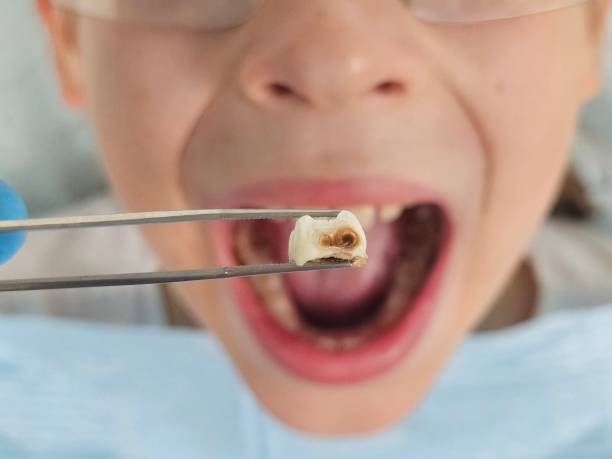 Best Emergency Dentist for Lost Fillings or Crowns in Berly, MO